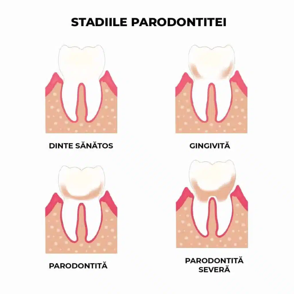 diagramă care ilustrează stadiile parodontitei, de la gingivită la parodontită avansată