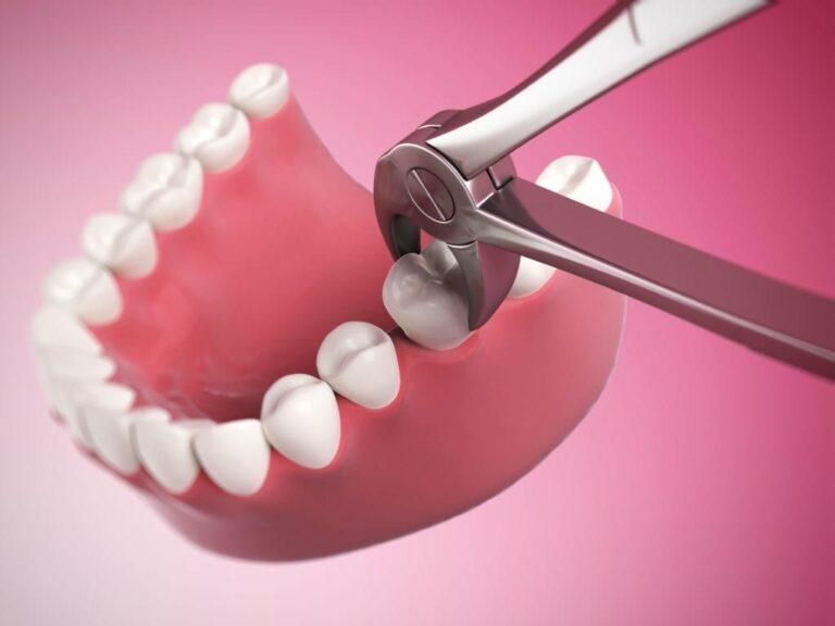 extractie dentara cluj