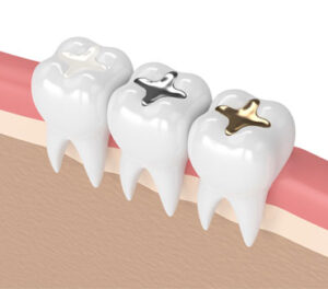 plombe dentare