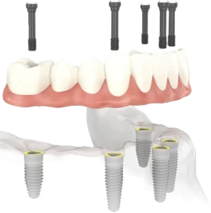 Ilustrație explicativă a tratamentului All-on-4 și All-on-6 – implanturi dentare pentru dantură fixă
