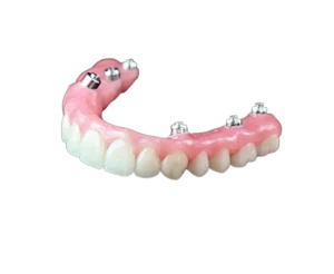 Ilustrație explicativă a sistemului All-on-6 pentru dantură fixă pe implanturi dentare