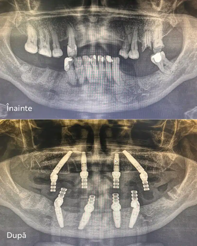 Radiografie panoramică înainte si dupa de tratamentul All‑on‑4 / All‑on‑6 – caz real MedPrime Cluj