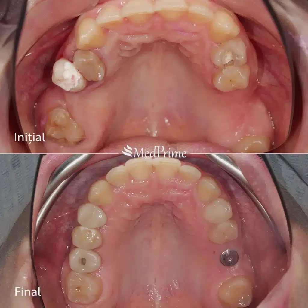 rezultat înainte și după tratament cu implant dentar