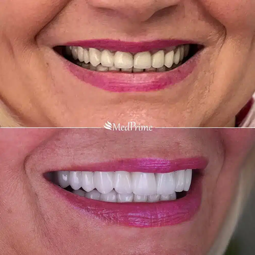 Caz real fațete dentare ceramice – înainte și după tratament estetic dentar la MedPrime Cluj