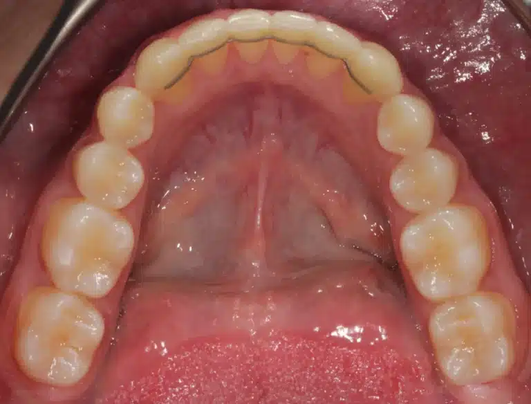 retainer fix lingual dupa aparat dentar MedPrime Cluj