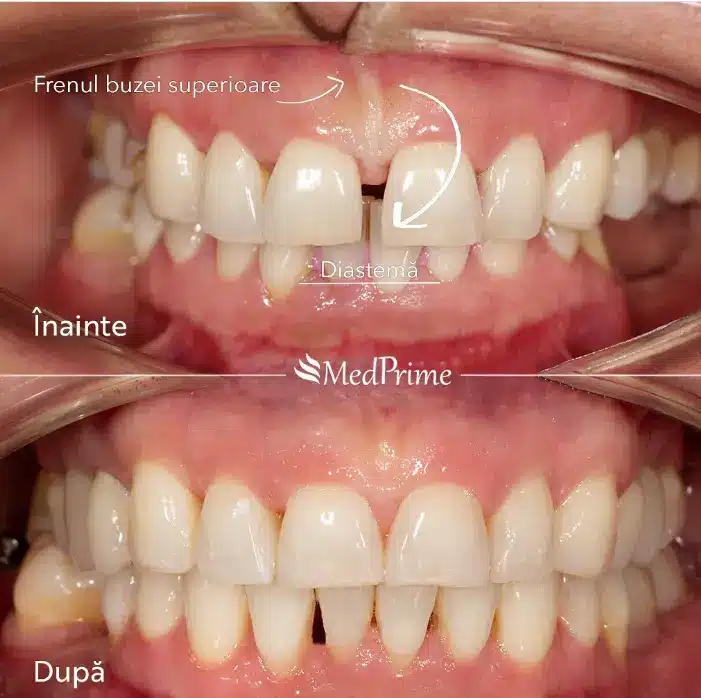 inainte si dupa aparat dentar Cluj corectare diastema