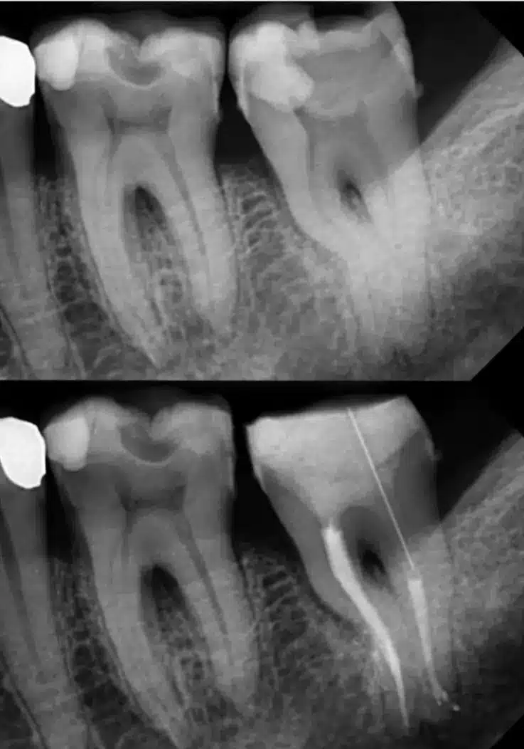 Radiografie înainte și după tratament endodontic realizat sub microscop dentar la MedPrime Cluj-Napoca