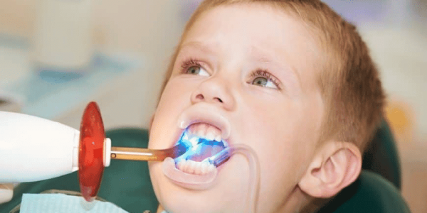 sigilare dentara copii